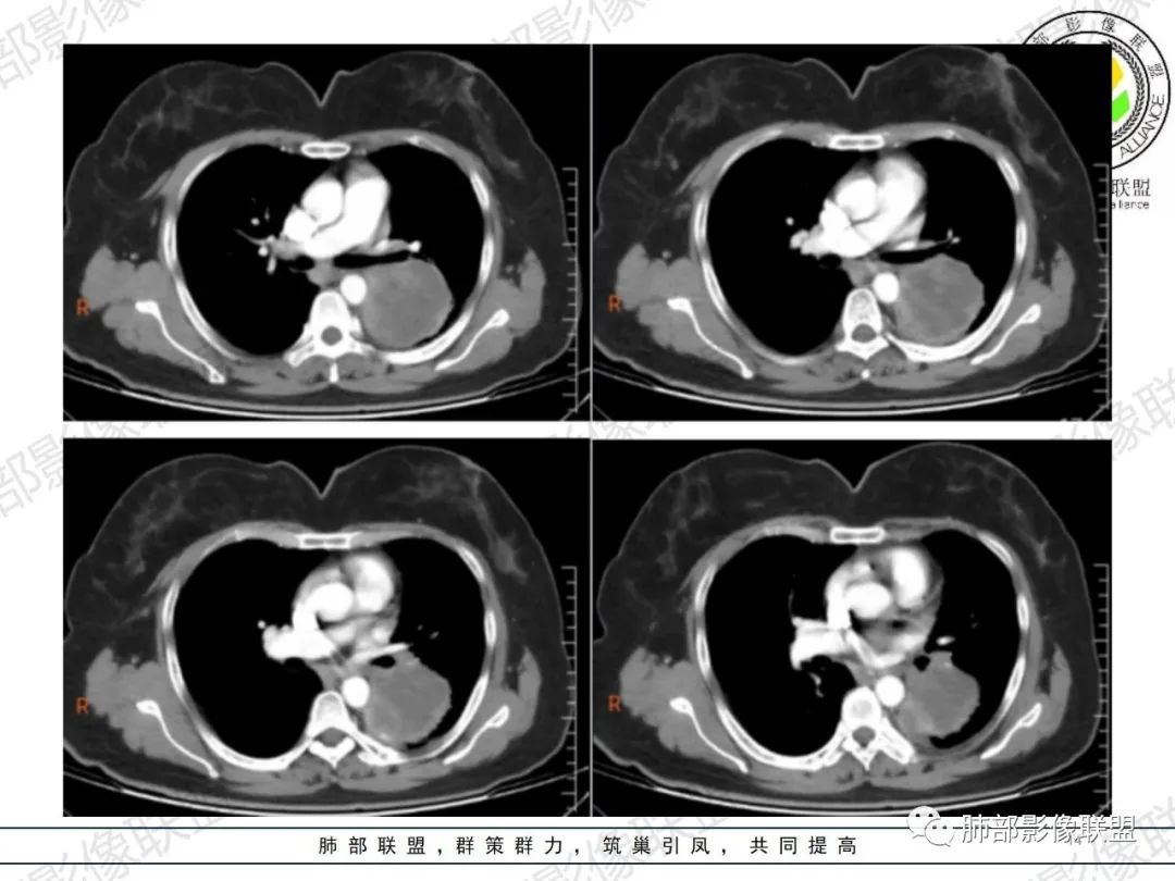 影像PPT - 【病例】左肺占位?纵隔占位?-14 影像PPT - 【病例】左肺占位?纵隔占位?-14