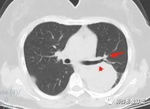 影像PPT - 【病例】左肺占位?纵隔占位?-24 影像PPT - 【病例】左肺占位?纵隔占位?-24