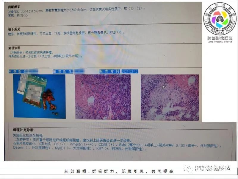 影像PPT - 【病例】左肺占位?纵隔占位?-29 影像PPT - 【病例】左肺占位?纵隔占位?-29
