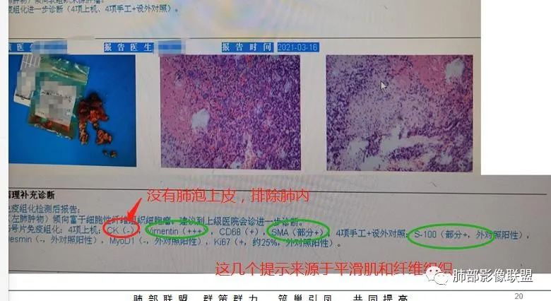影像PPT - 【病例】左肺占位?纵隔占位?-30 影像PPT - 【病例】左肺占位?纵隔占位?-30