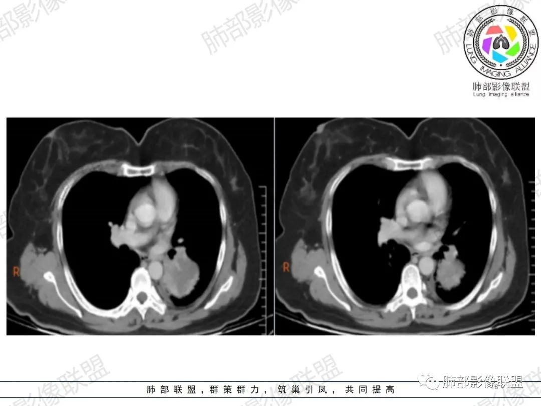 影像PPT - 【病例】左肺占位?纵隔占位?-18 影像PPT - 【病例】左肺占位?纵隔占位?-18