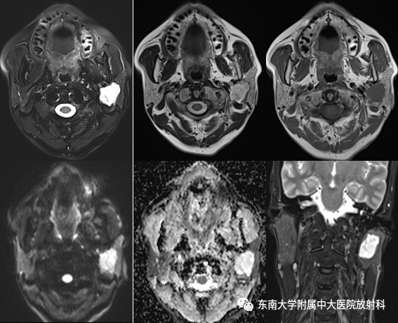 影像PPT - 【PPT】腮腺多形性腺瘤-1