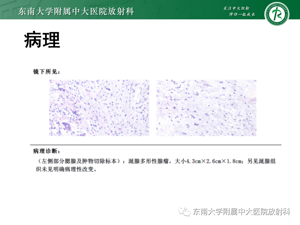 影像PPT - 【PPT】腮腺多形性腺瘤-3