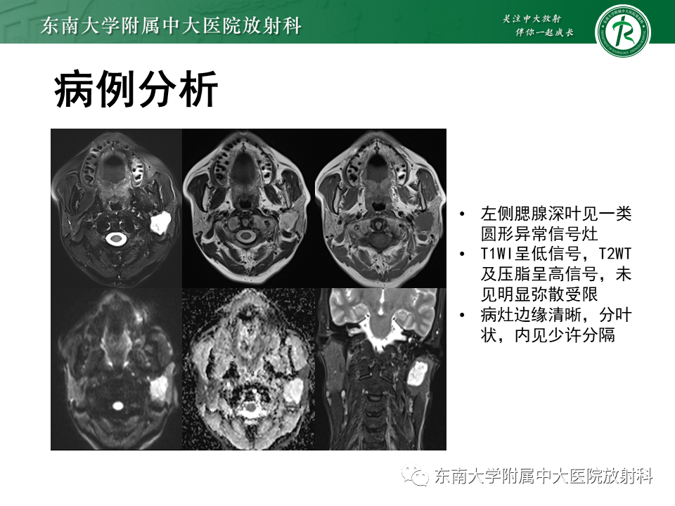 影像PPT - 【PPT】腮腺多形性腺瘤-2