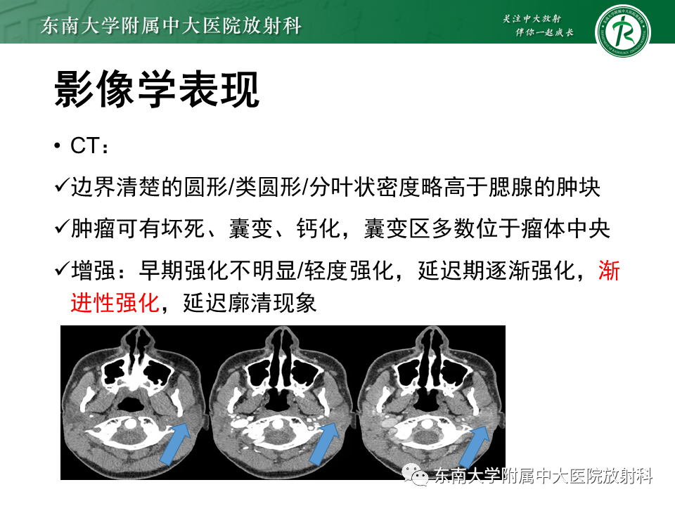 影像PPT - 【PPT】腮腺多形性腺瘤-10