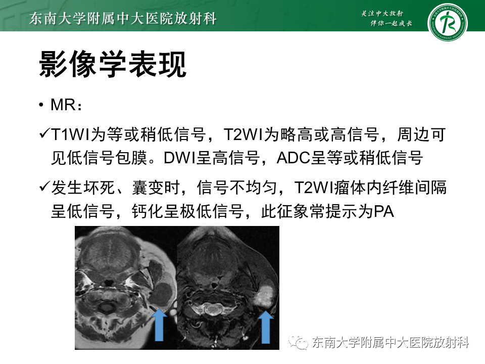 影像PPT - 【PPT】腮腺多形性腺瘤-11