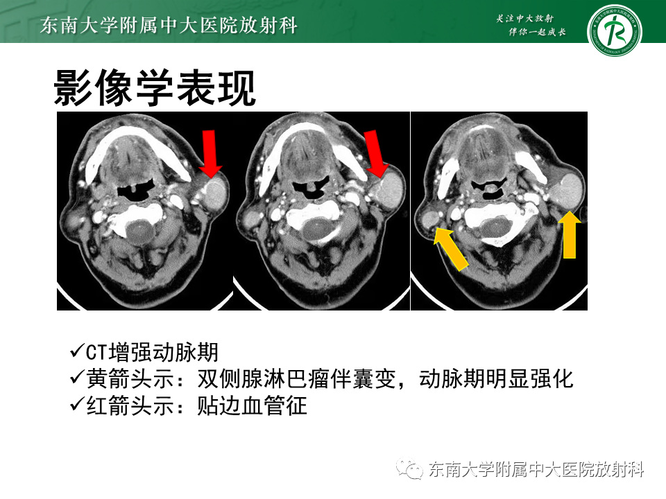 影像PPT - 【PPT】腮腺多形性腺瘤-14
