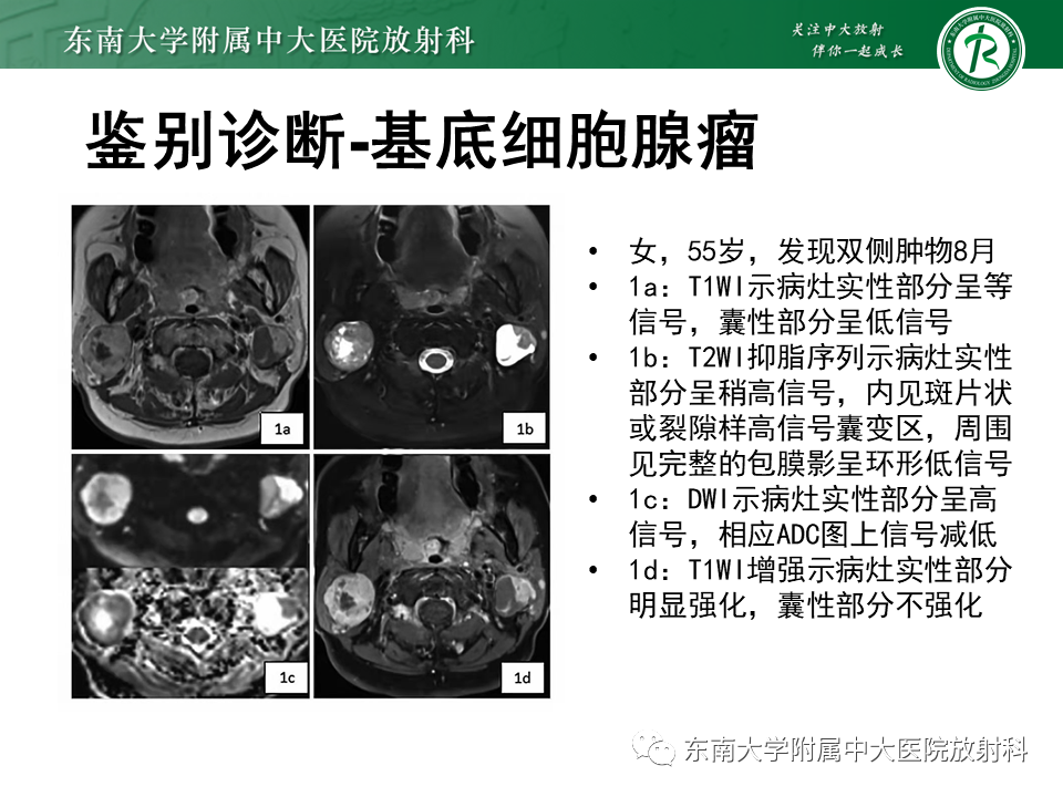 影像PPT - 【PPT】腮腺多形性腺瘤-16