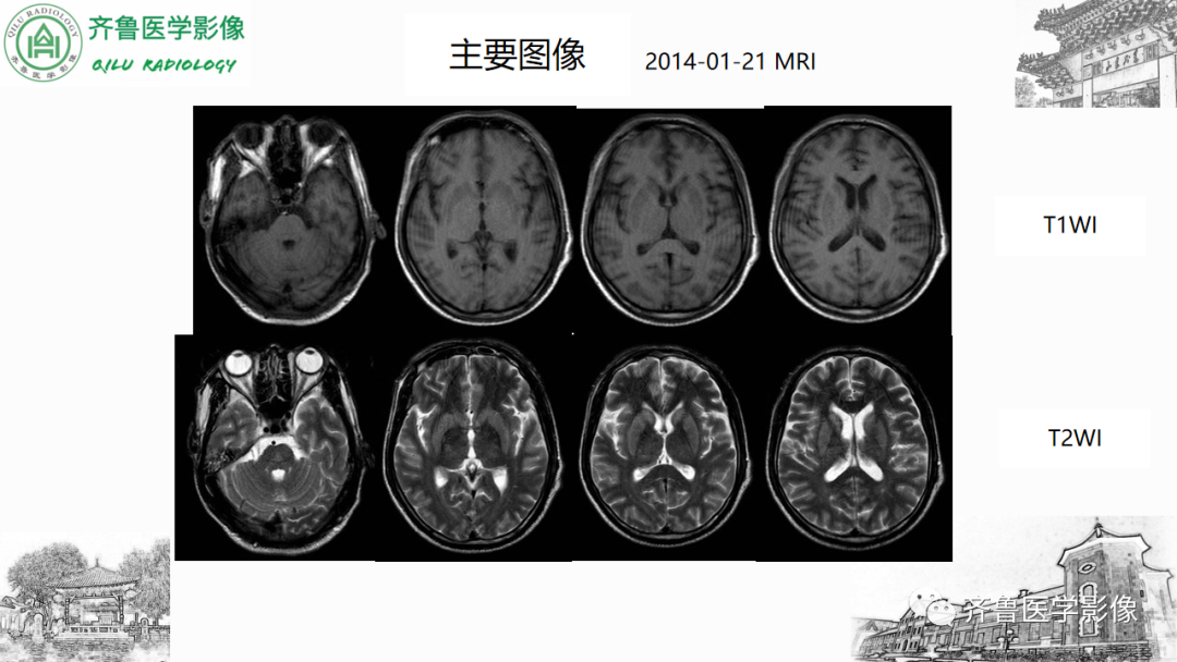 影像PPT - 【PPT】渗透性脱髓鞘综合征-3