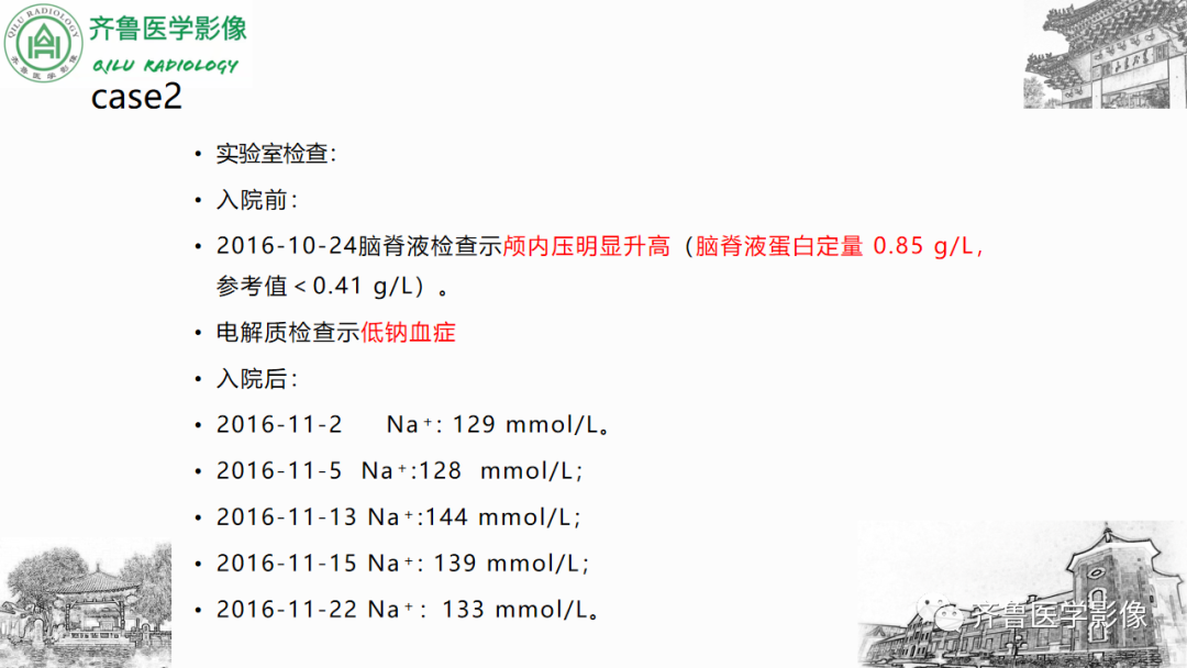 影像PPT - 【PPT】渗透性脱髓鞘综合征-21