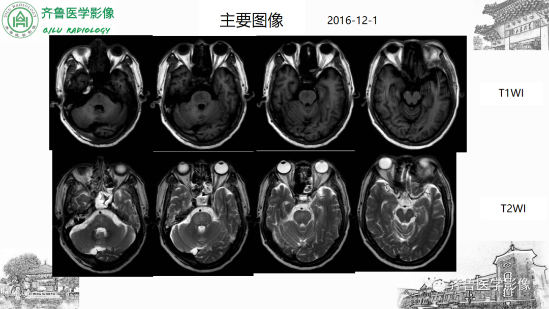 影像PPT - 【PPT】渗透性脱髓鞘综合征-25