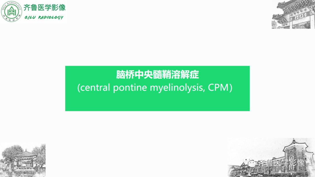 影像PPT - 【PPT】渗透性脱髓鞘综合征-19
