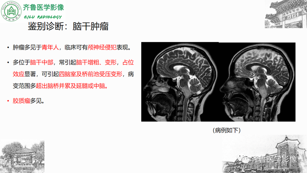 影像PPT - 【PPT】渗透性脱髓鞘综合征-31