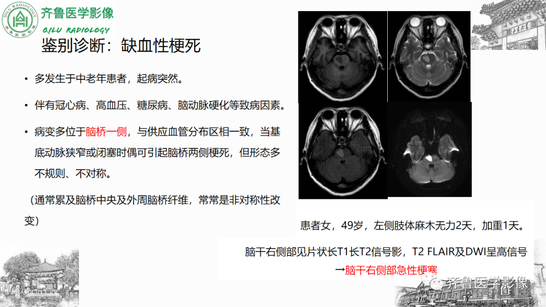 影像PPT - 【PPT】渗透性脱髓鞘综合征-30
