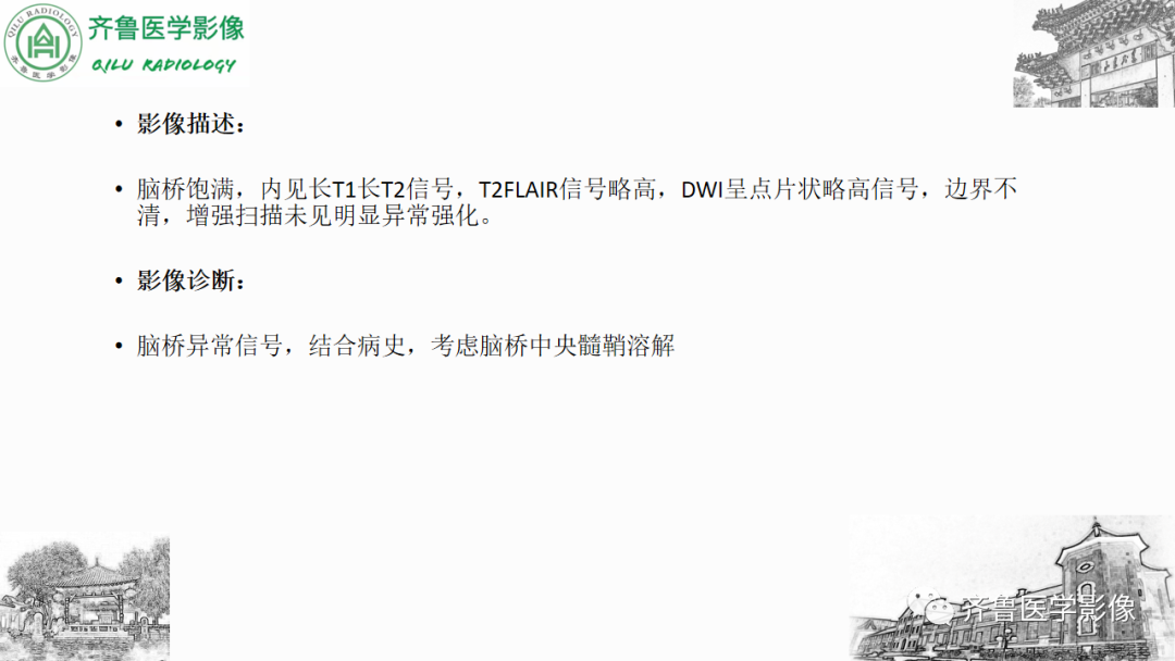 影像PPT - 【PPT】渗透性脱髓鞘综合征-27