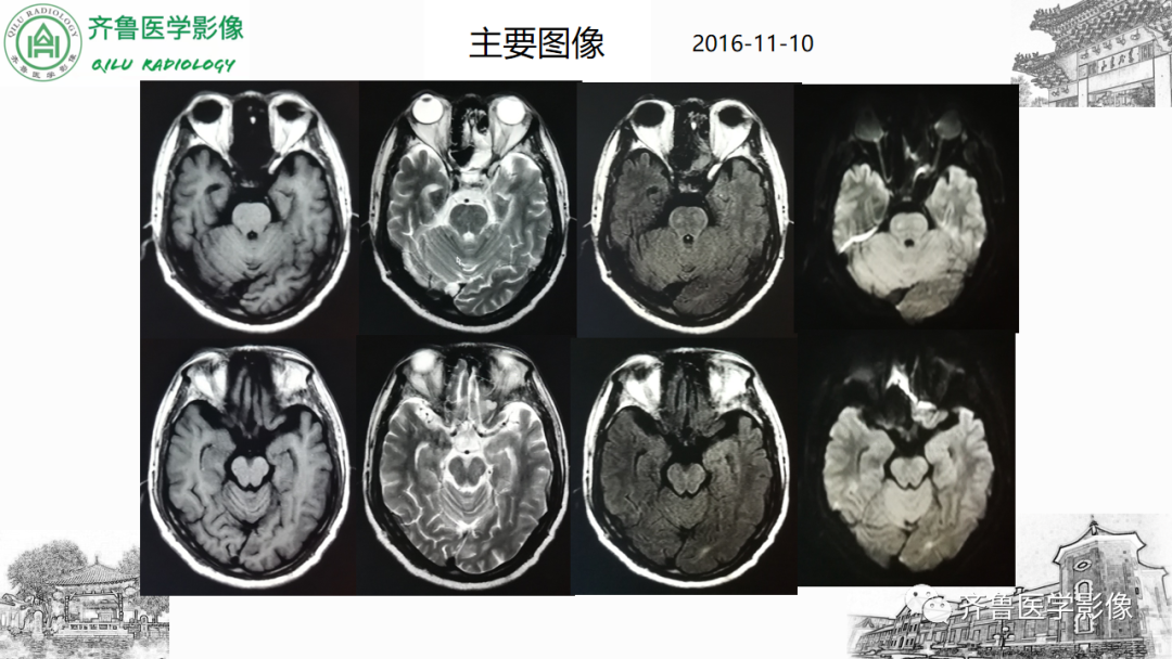 影像PPT - 【PPT】渗透性脱髓鞘综合征-24