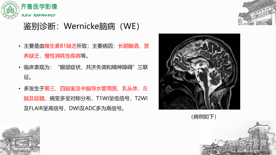影像PPT - 【PPT】渗透性脱髓鞘综合征-33