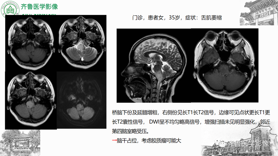 影像PPT - 【PPT】渗透性脱髓鞘综合征-32