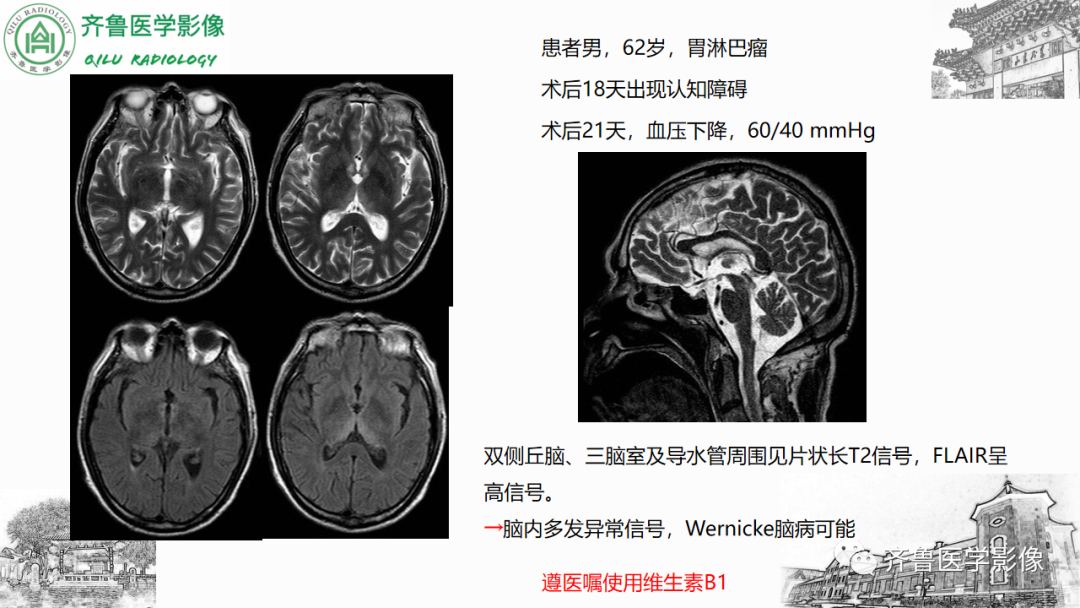 影像PPT - 【PPT】渗透性脱髓鞘综合征-34