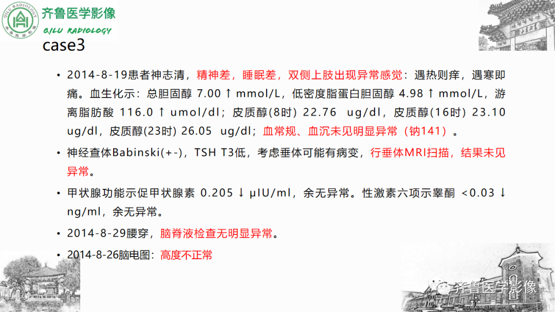 影像PPT - 【PPT】渗透性脱髓鞘综合征-39