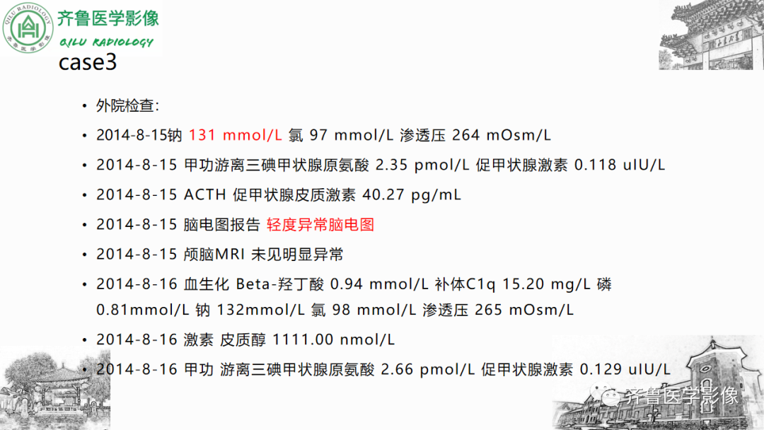 影像PPT - 【PPT】渗透性脱髓鞘综合征-38