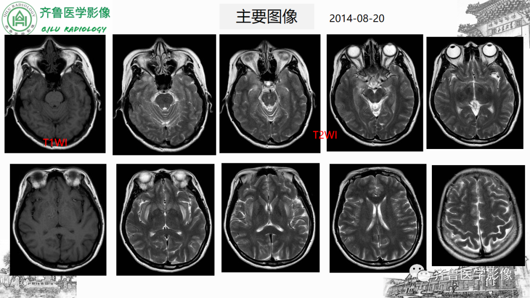影像PPT - 【PPT】渗透性脱髓鞘综合征-40