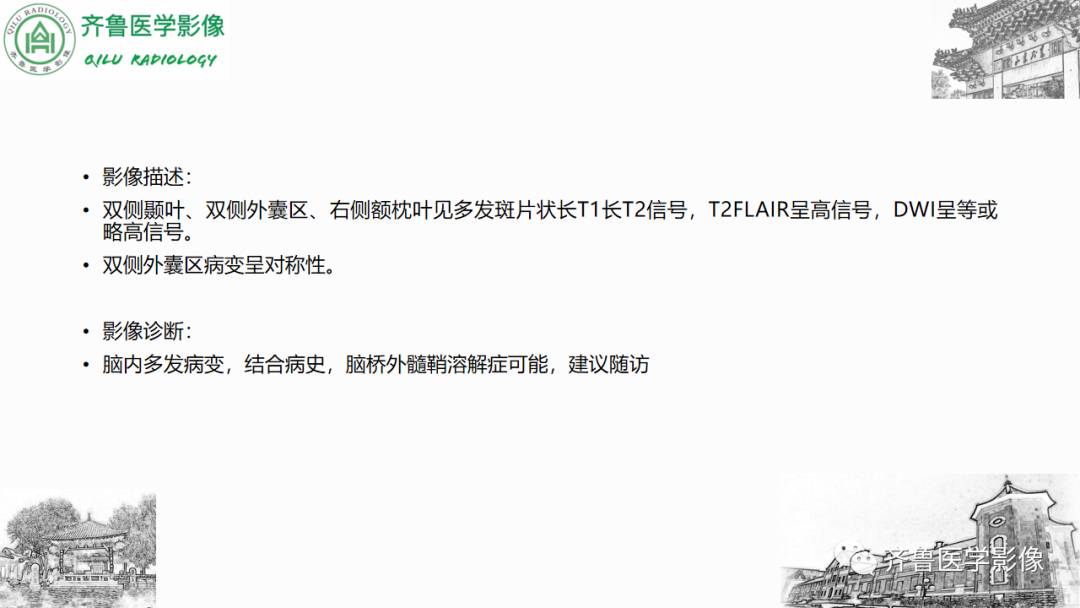 影像PPT - 【PPT】渗透性脱髓鞘综合征-42