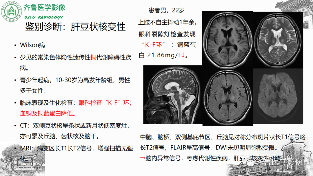 影像PPT - 【PPT】渗透性脱髓鞘综合征-44