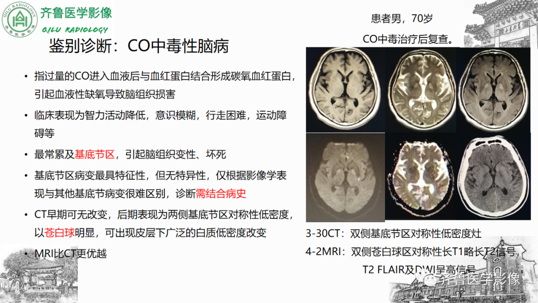 影像PPT - 【PPT】渗透性脱髓鞘综合征-45
