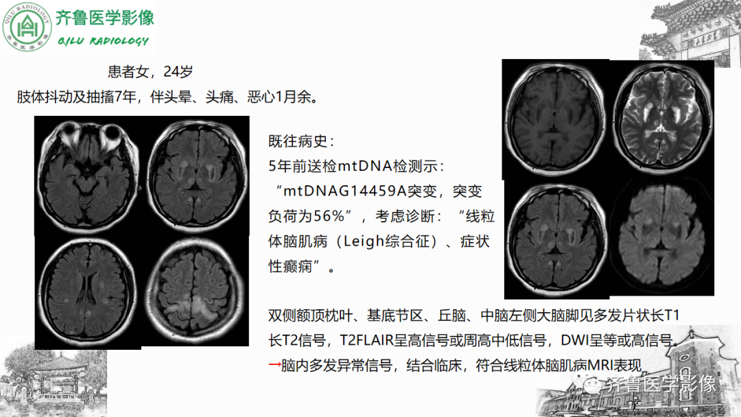 影像PPT - 【PPT】渗透性脱髓鞘综合征-47