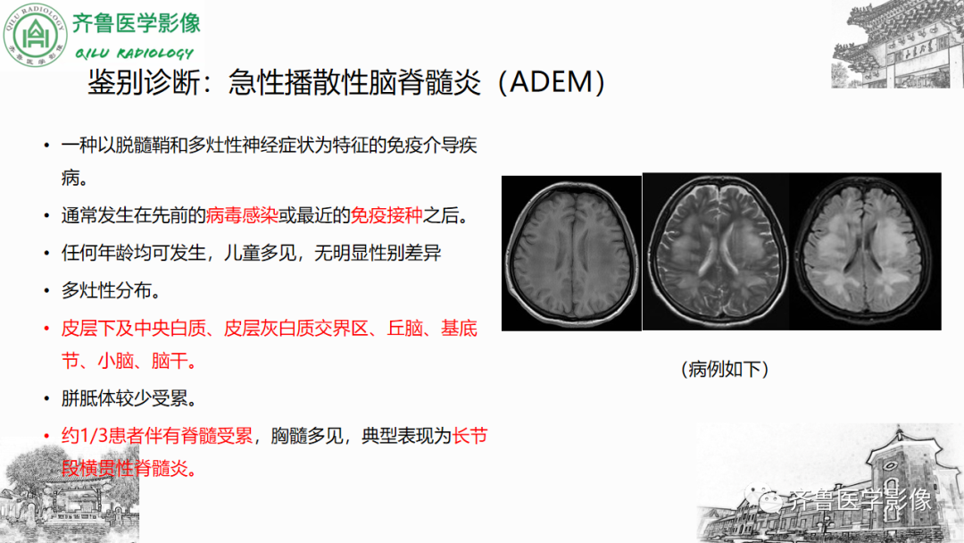 影像PPT - 【PPT】渗透性脱髓鞘综合征-48