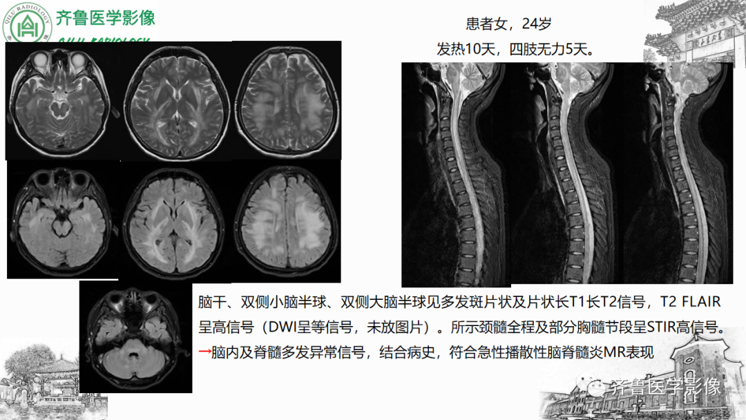 影像PPT - 【PPT】渗透性脱髓鞘综合征-49
