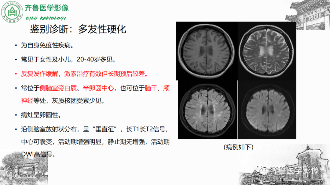 影像PPT - 【PPT】渗透性脱髓鞘综合征-50