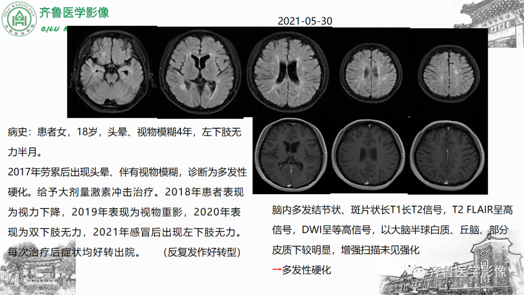 影像PPT - 【PPT】渗透性脱髓鞘综合征-51