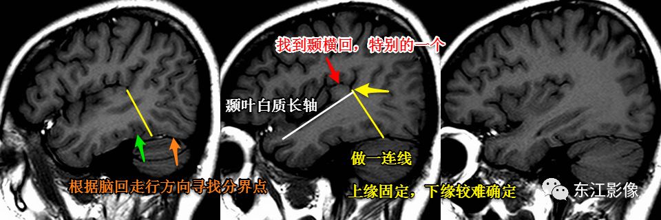 影像PPT - 注意识别头颅MRI阅片中易混淆的解剖结构-5 影像PPT - 注意识别头颅MRI阅片中易混淆的解剖结构-5