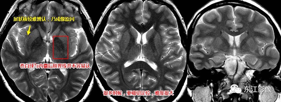 影像PPT - 注意识别头颅MRI阅片中易混淆的解剖结构-1 影像PPT - 注意识别头颅MRI阅片中易混淆的解剖结构-1