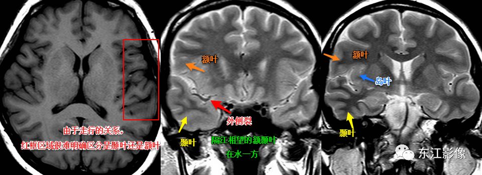 影像PPT - 注意识别头颅MRI阅片中易混淆的解剖结构-6 影像PPT - 注意识别头颅MRI阅片中易混淆的解剖结构-6