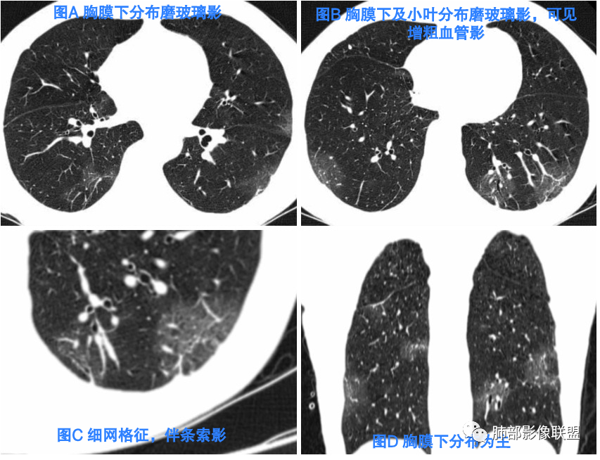 影像PPT - 【病例】新冠肺炎早期3例CT征象分析-3 影像PPT - 【病例】新冠肺炎早期3例CT征象分析-3