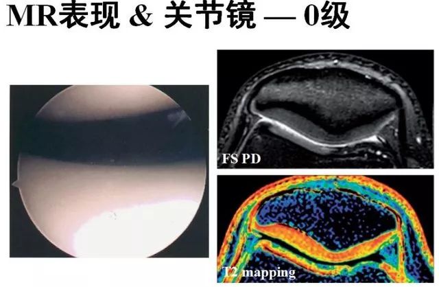 影像PPT - 从病理到影像:全面解析髌骨软化症-9 影像PPT - 从病理到影像:全面解析髌骨软化症-9