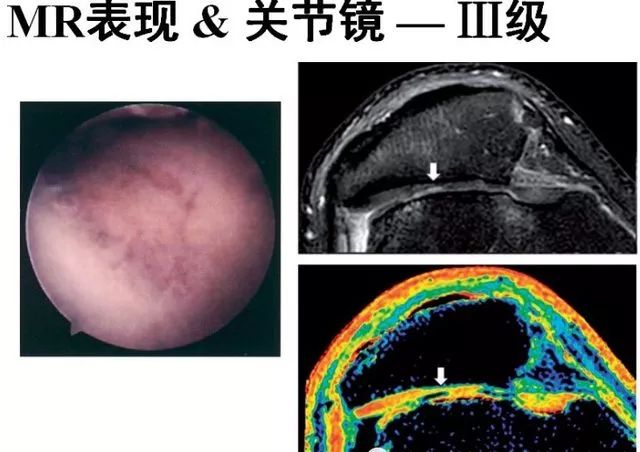 影像PPT - 从病理到影像:全面解析髌骨软化症-12 影像PPT - 从病理到影像:全面解析髌骨软化症-12