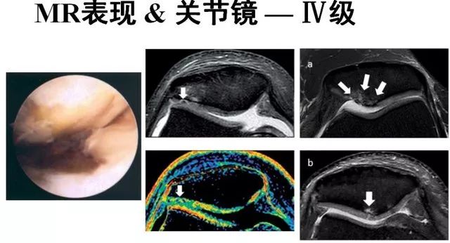 影像PPT - 从病理到影像:全面解析髌骨软化症-13 影像PPT - 从病理到影像:全面解析髌骨软化症-13