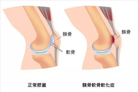 影像PPT - 从病理到影像:全面解析髌骨软化症-2 影像PPT - 从病理到影像:全面解析髌骨软化症-2