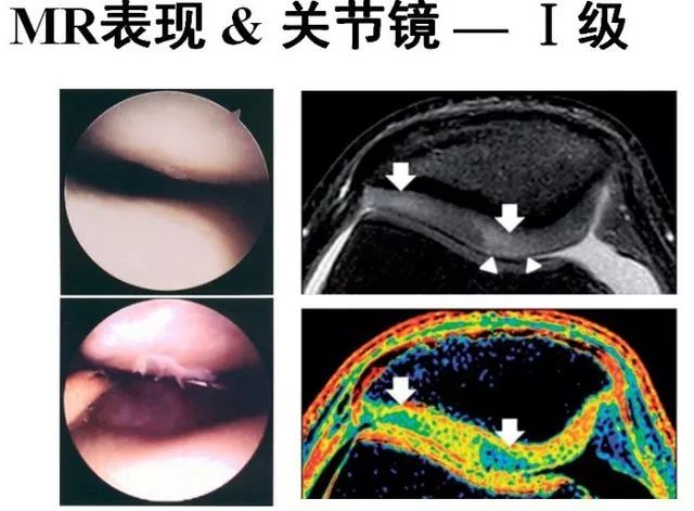影像PPT - 从病理到影像:全面解析髌骨软化症-10 影像PPT - 从病理到影像:全面解析髌骨软化症-10