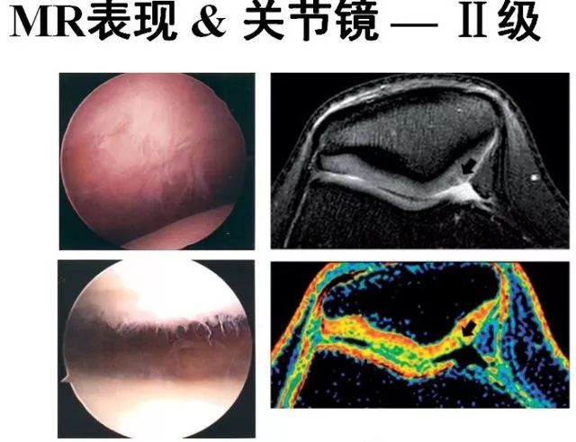 影像PPT - 从病理到影像:全面解析髌骨软化症-11 影像PPT - 从病理到影像:全面解析髌骨软化症-11