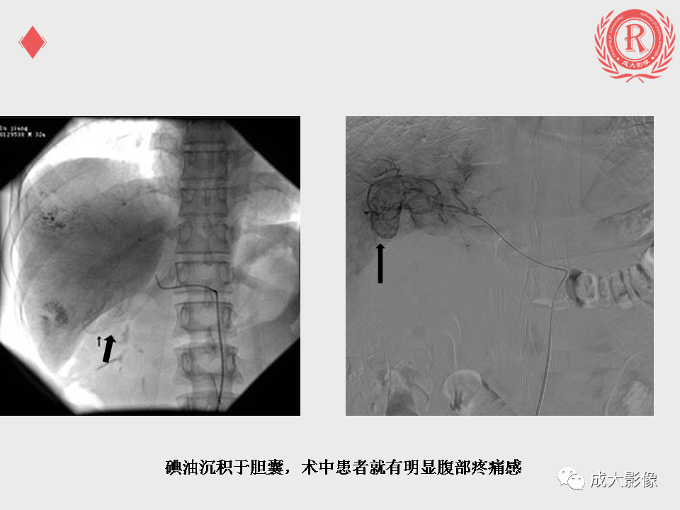 影像PPT - 【PPT】肝癌TACE治疗并发症-9