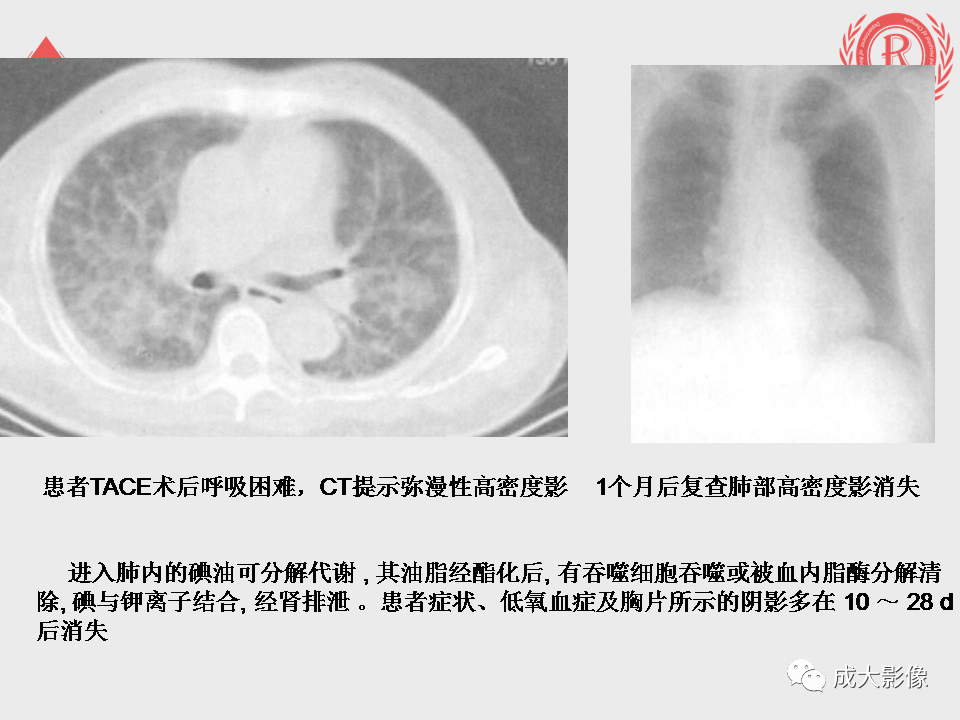影像PPT - 【PPT】肝癌TACE治疗并发症-11