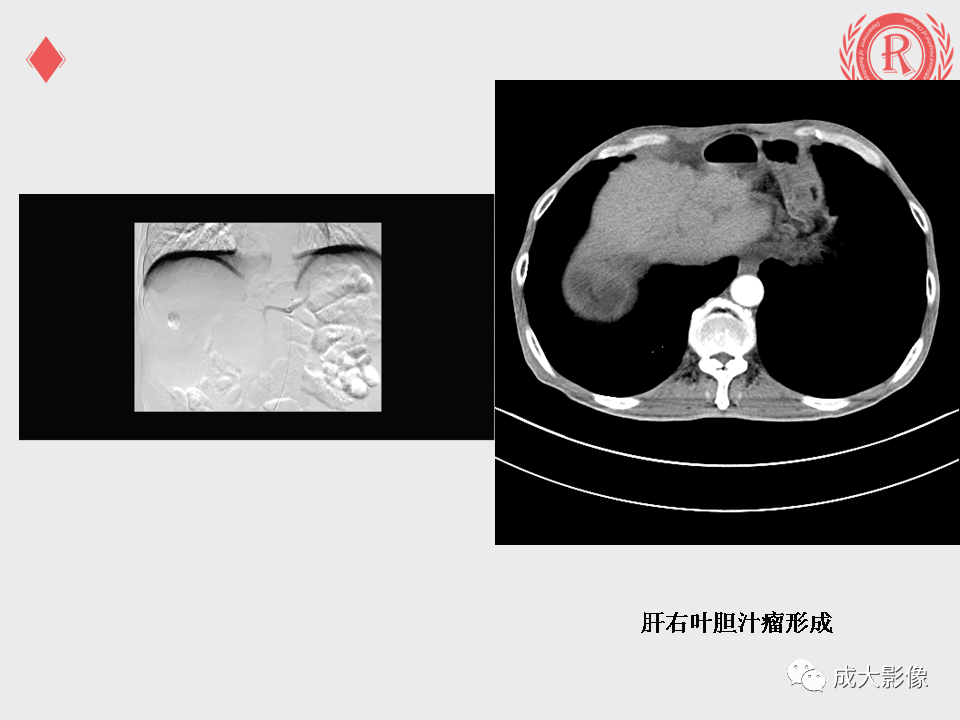 影像PPT - 【PPT】肝癌TACE治疗并发症-15