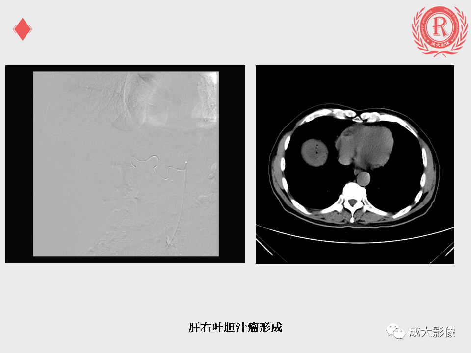 影像PPT - 【PPT】肝癌TACE治疗并发症-16