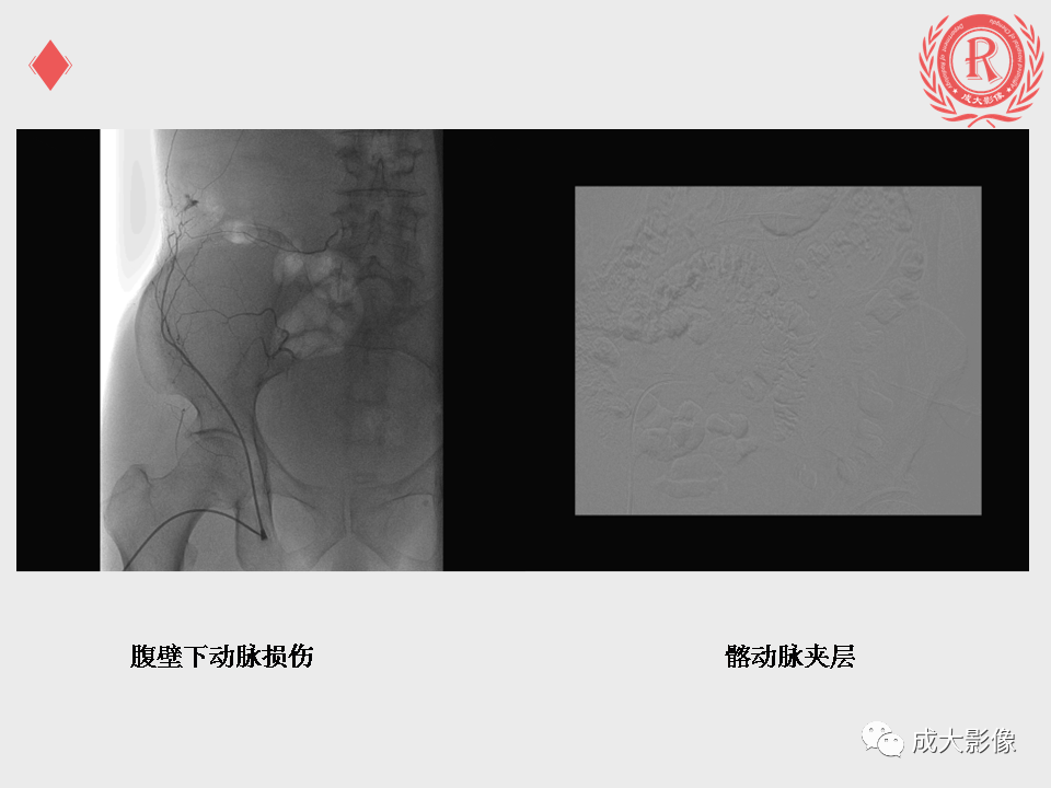 影像PPT - 【PPT】肝癌TACE治疗并发症-21