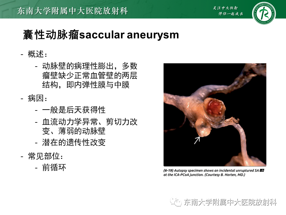 影像PPT - 【PPT】颅内动脉瘤-12